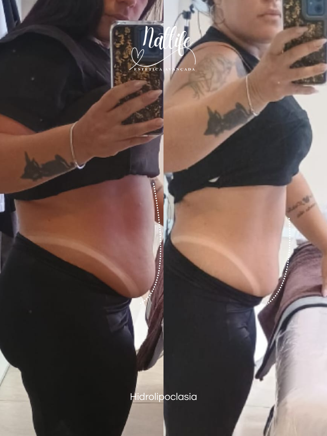 5 Sessões de Hidrolipoclasia