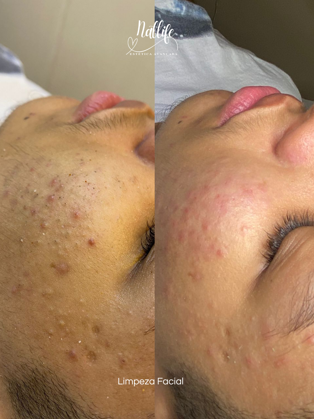 Limpeza Facial Adolescente