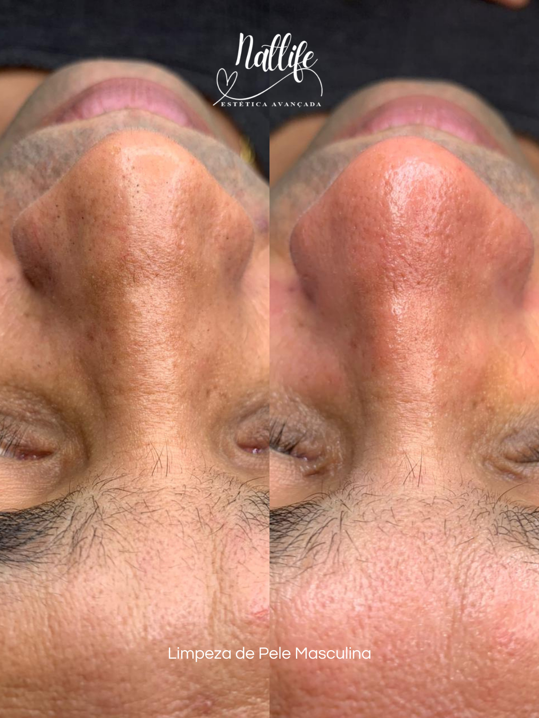 Limpeza Facial Masculina