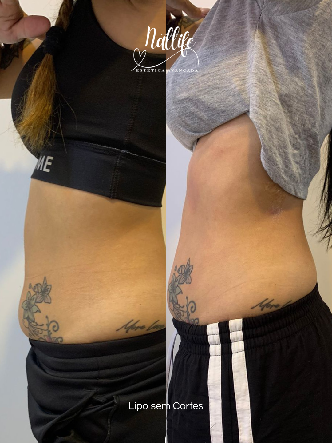 Lipo sem corte 1