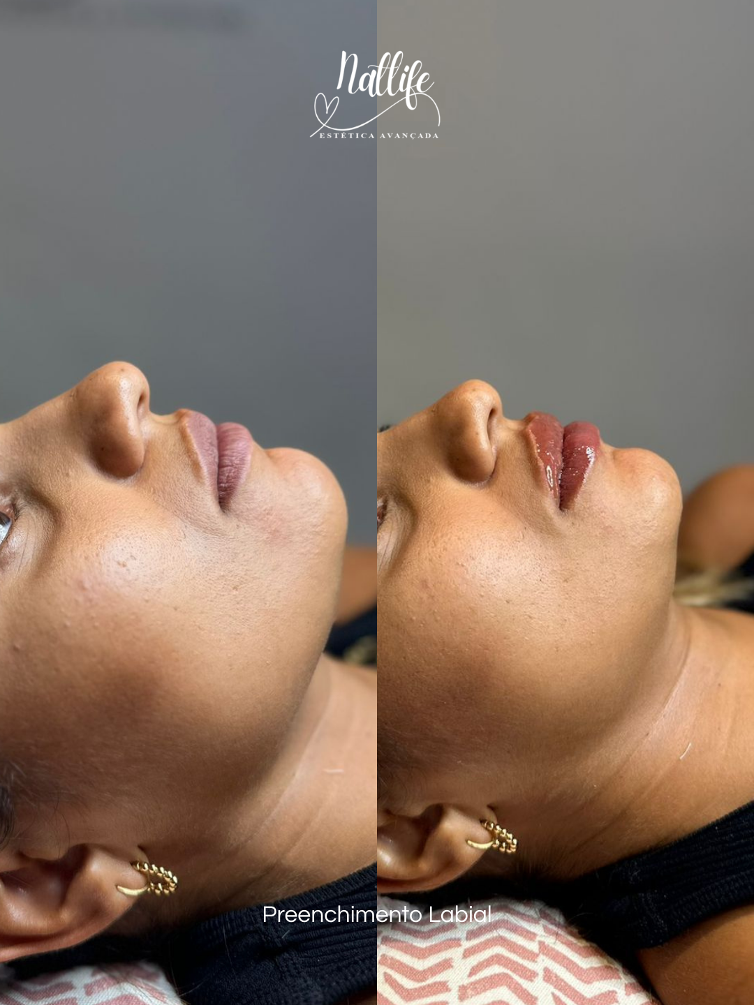 Preenchimento Labial 2