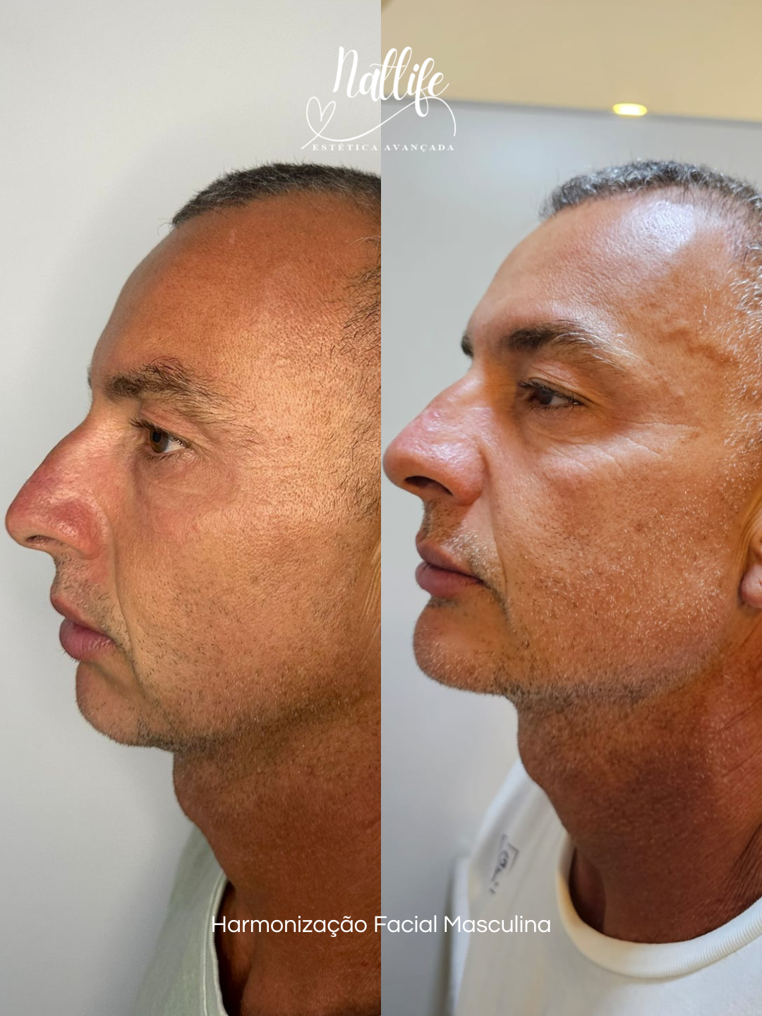 Harmonização Facial