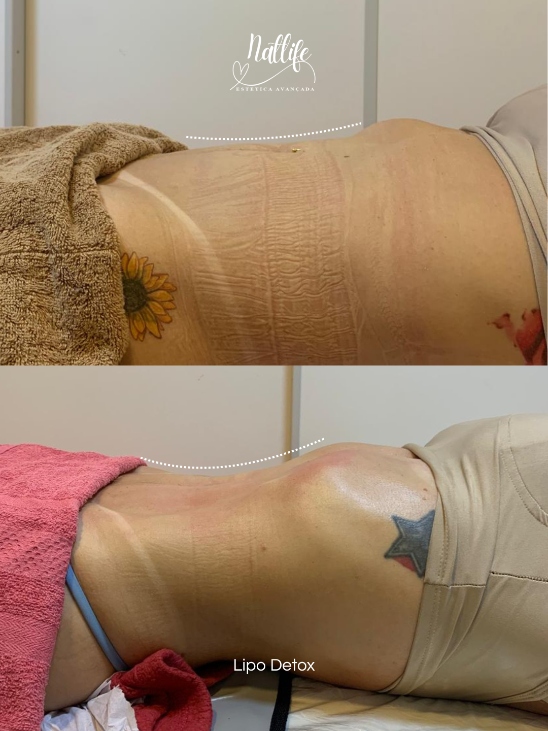 Lipo Detox