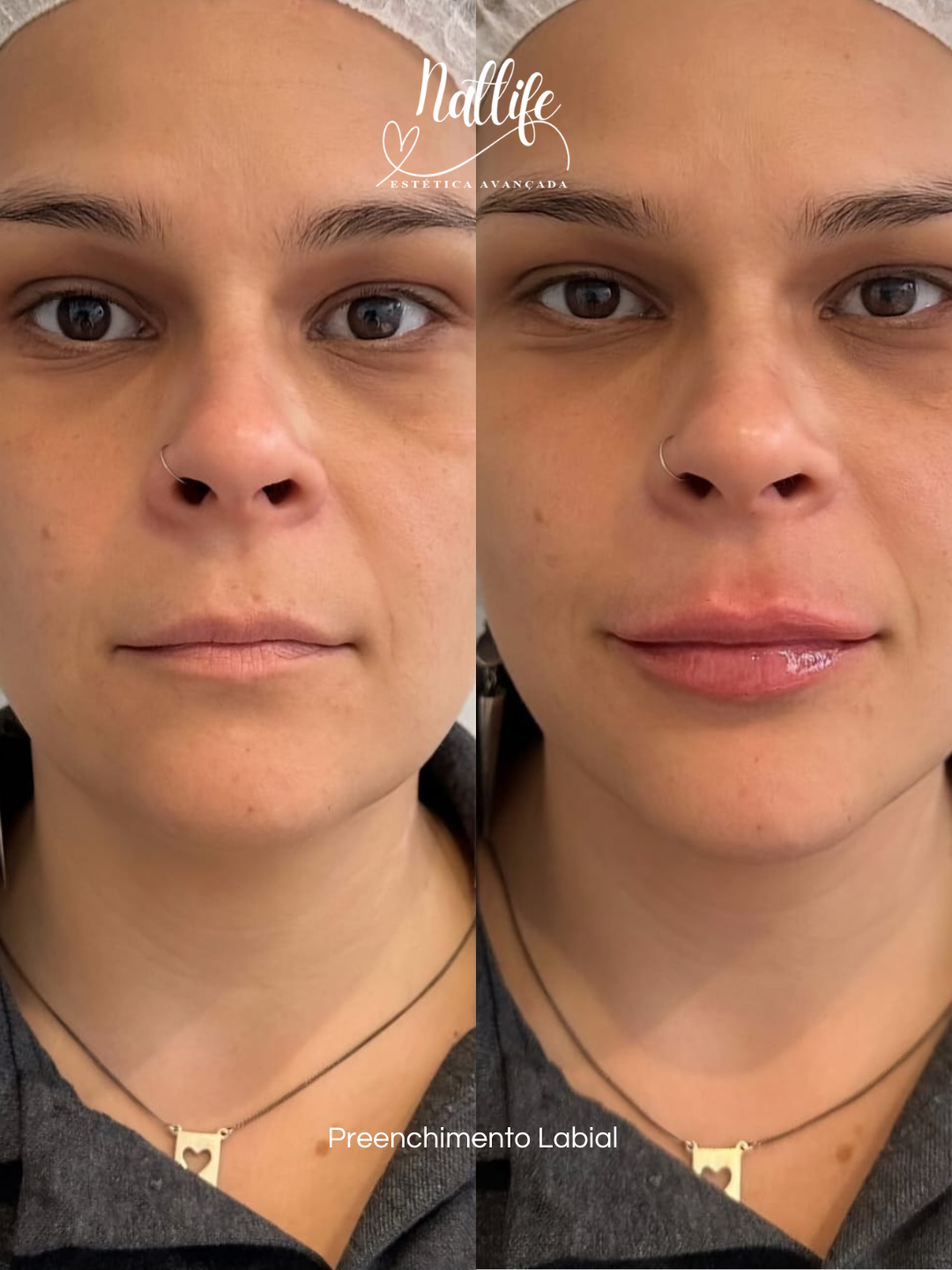 Preenchimento Labial